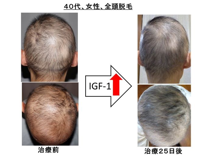 円形脱毛症　病院